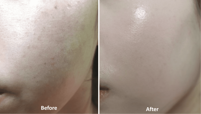 Atelocollagen - Before/After