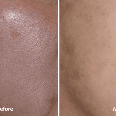Atelocollagen - Before/After