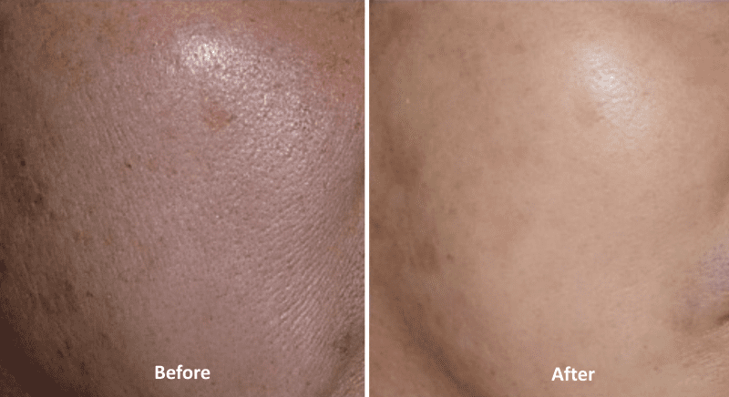 Atelocollagen - Before/After